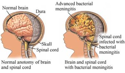 Causes Cerebral Palsy